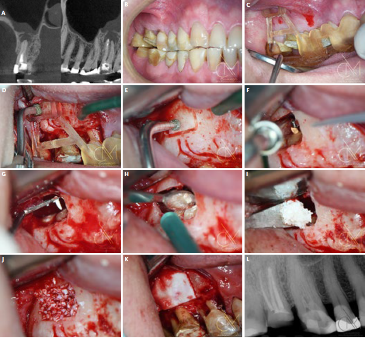 | A Coronal and sagittal cone-bean computed tomography (CBCT) showing proximity of the periapical lesion and the maxillary sinus. | B Right occlusion before treatment. | C Surgical 3D template to guide access. | D Osteotomy with Piezotome Cube (Acteon US) using the SL1 tip after the flap was raised. | E Osteotomy with Piezotome Cube (Acteon US) using the SL2 tip. | F Retro preparation on the mesiobuccal root with a Berutti tip (EMS Switzerland) under saline irrigation. | G Biocement Bio C Repair (Angelus, Brazil) placed in the mesiobuccal canal. | H 3 mm photography micromirror checking the retrofilling in the distobuccal root of the upper right second molar. | I Geistlich Bio-Oss® Small 0,5 g. (Geistlich Pharma AG, Switzerland) at the surgical site. | J Surgical cavity filled with Geistlich Bio-Oss® Small. | K Geistlich Bio-Gide® 25 × 25 membrane used to cover the graft. | L Final radiography post surgery.