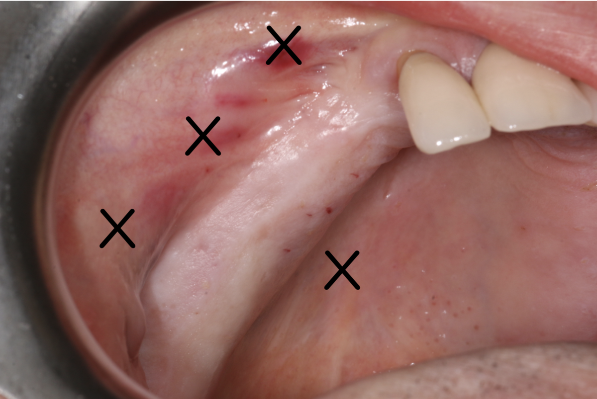 Fig 1. Local anesthetic for vestibular infiltration 