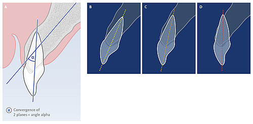Fig. 1: Angulation
| A Illustration of tooth-root angulation
| B Mild angulation 
| C Moderate angulation
| D Severe angulation