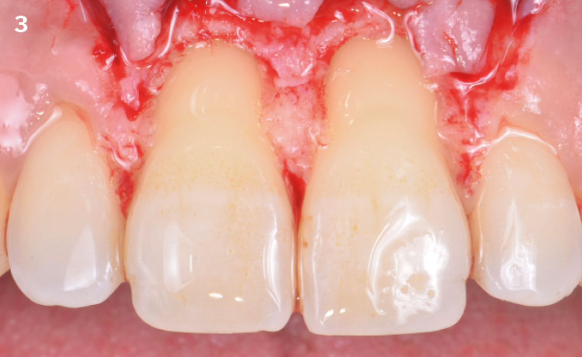 3 | Split-full-split thickness flap, the anatomical papillae are de-epithelized. The roots are smoothed with curettes.