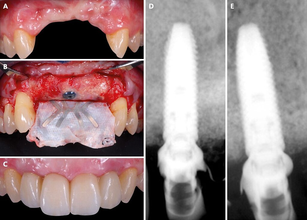 Regeneration Expert 3 Key protocols for horizontal and vertical bone