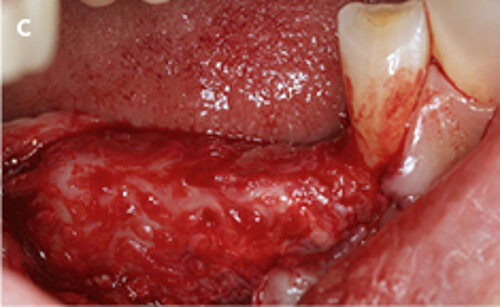 C | Geistlich Bio-Gide® membrane is used to
cover the customized mesh.