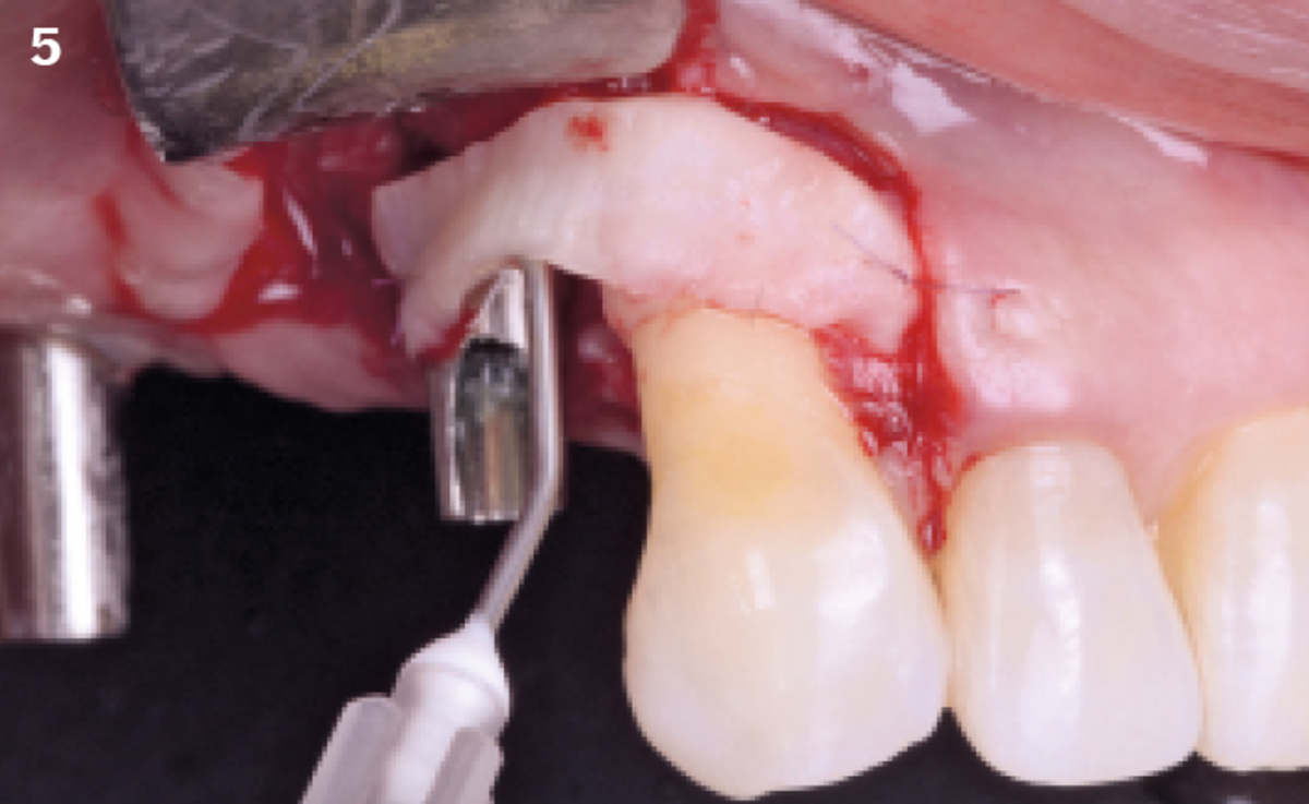 5 | A free gingival graft harvested from the palate is applied on tooth 13 and the affected site