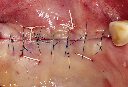 3/6 Primary wound closure.