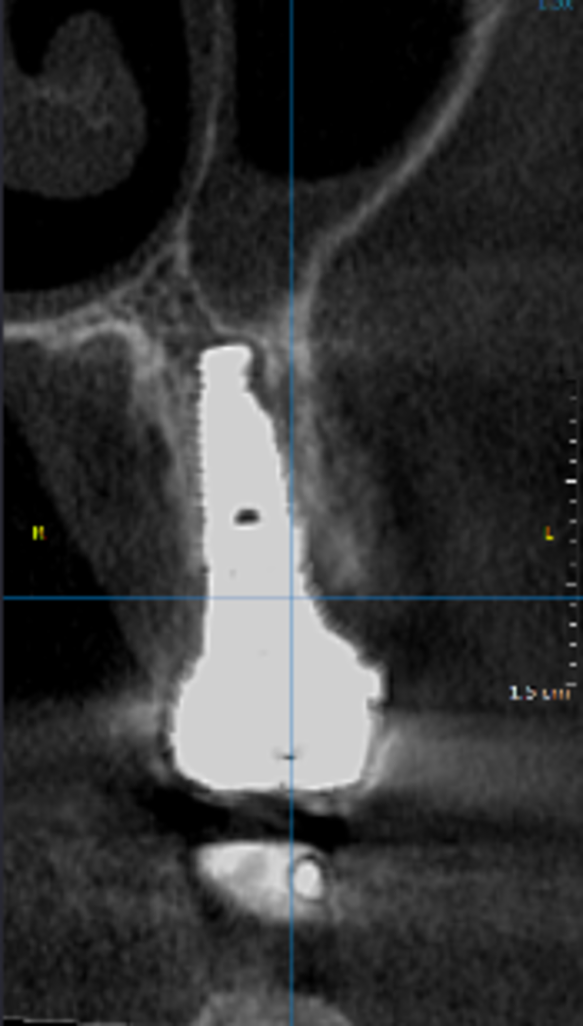 CBCT at 1 year 