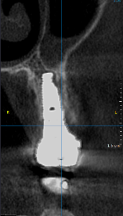and CBCT at 1-year 
