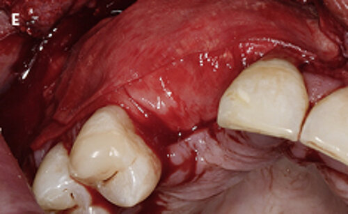 E | Bone block covered with Geistlich Bio-Gide® (courtesy of Prof. V. Chappuis, University of Bern, Switzerland).