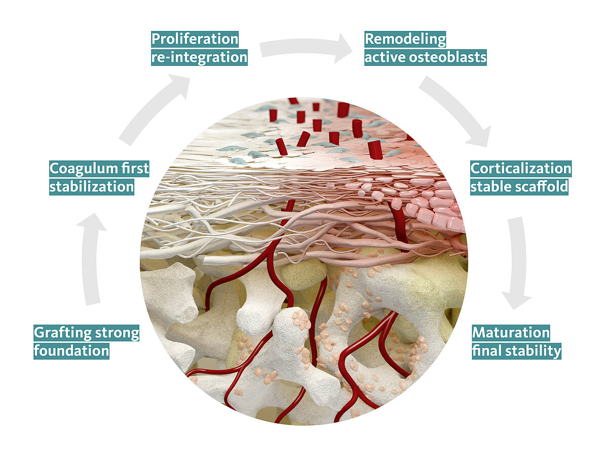 [Portuguese] From grafting to maturation of Geistlich Bio-Gide​​​​​​​®