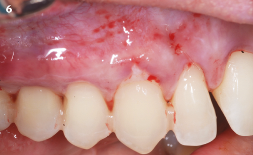 6 | Connective tissue positioned at the cementoenamel junction on the canine.