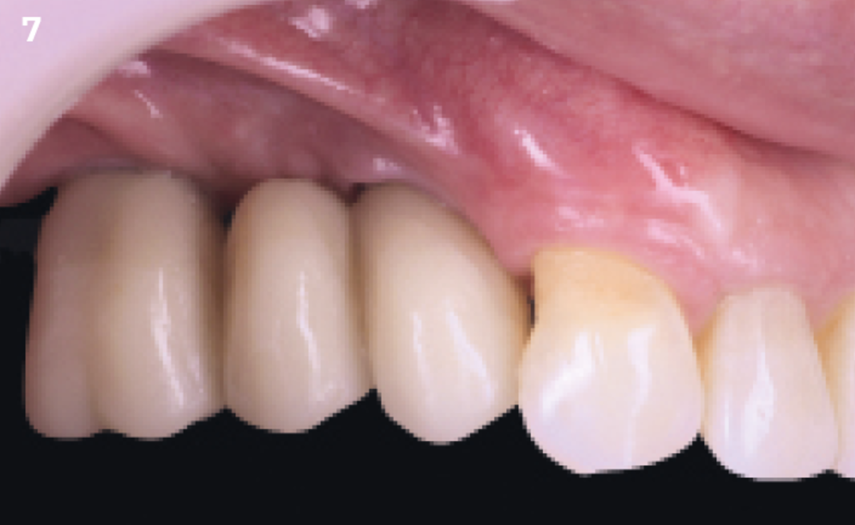 7 | Temporary crowns on multi-unit abutments.