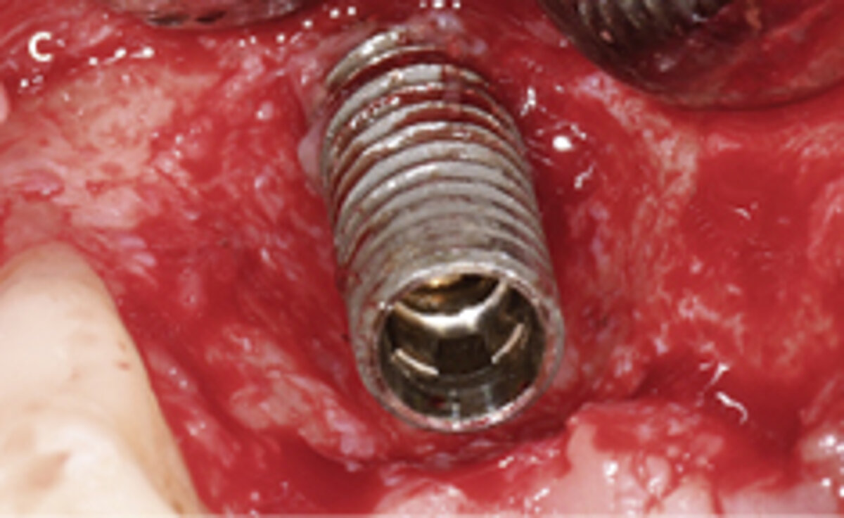 C | Intrasurgical situation of bone level implant 13 before explantation.