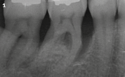 1 | Radiographic image before
treatment