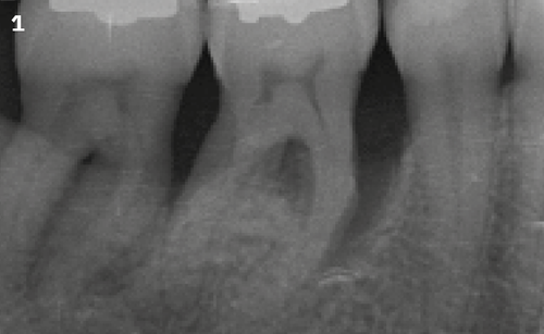 1 | Radiographic image before
treatment