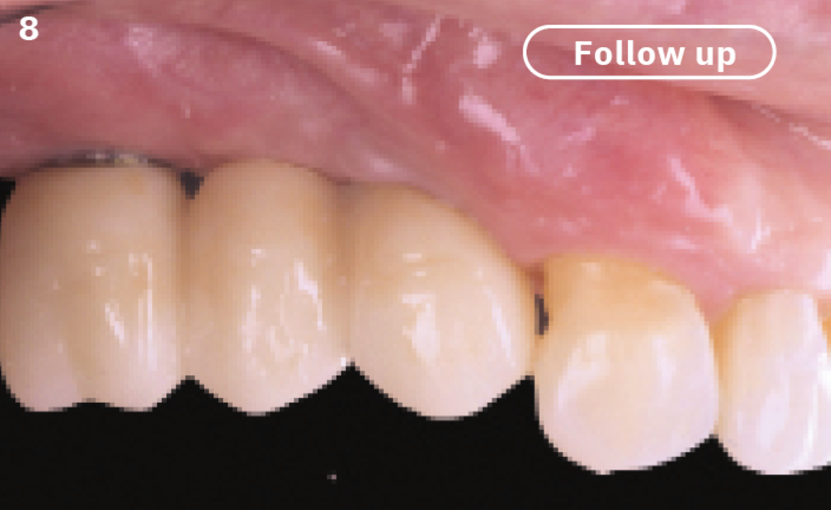 8 | Permanent crowns on multi-unit abutments 1 year after surgery