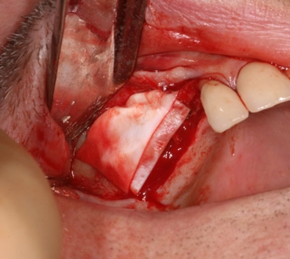 Fig 9- Using Geistlich Bio-Gide® to protect the grafted area