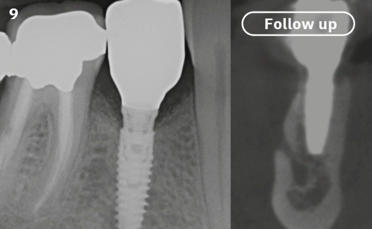 9 | The stability of the hard tissue is visible both with the 2D examination and at the 3D level (12 months).