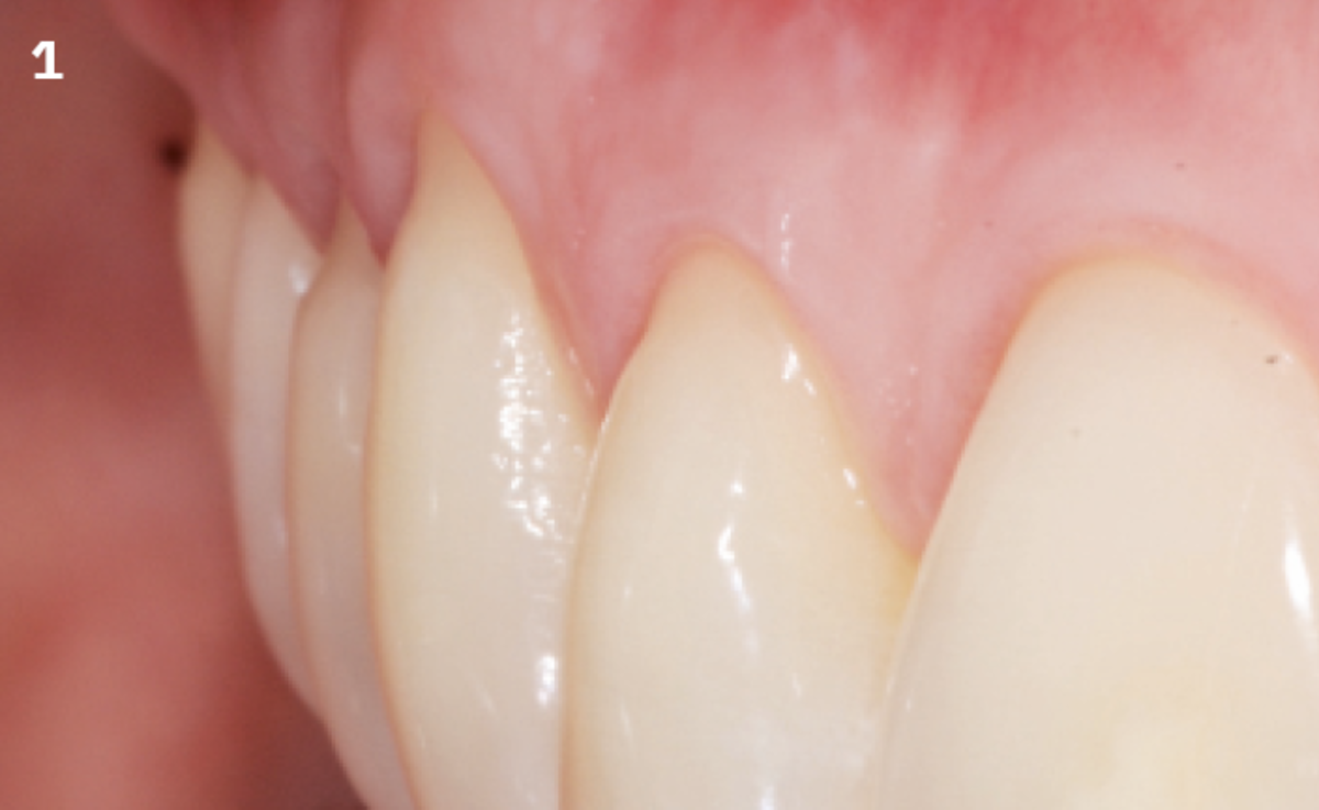 1 | Pre-operative situation: Miller class I multiple gingival recession on teeth 11 to 14, 1-2 mm depth. Sufficient keratinized tissue height.