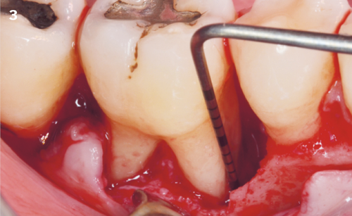 3 | Intraoperative
view of the infrabony defect