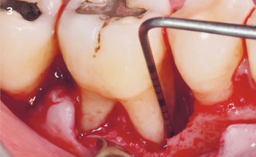 3 | Intraoperative
view of the infrabony defect