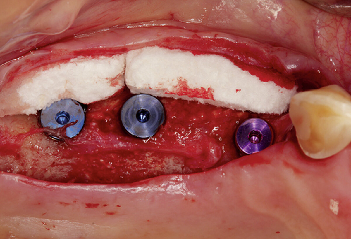 2/6 Augmentation of soft tissue thickness with Geistlich Fibro-Gide® at the time of implant placement.