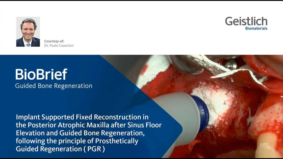 Major Bone Augmentation - Prosthetically Guided Regeneration (PGR) in the posterior maxilla.