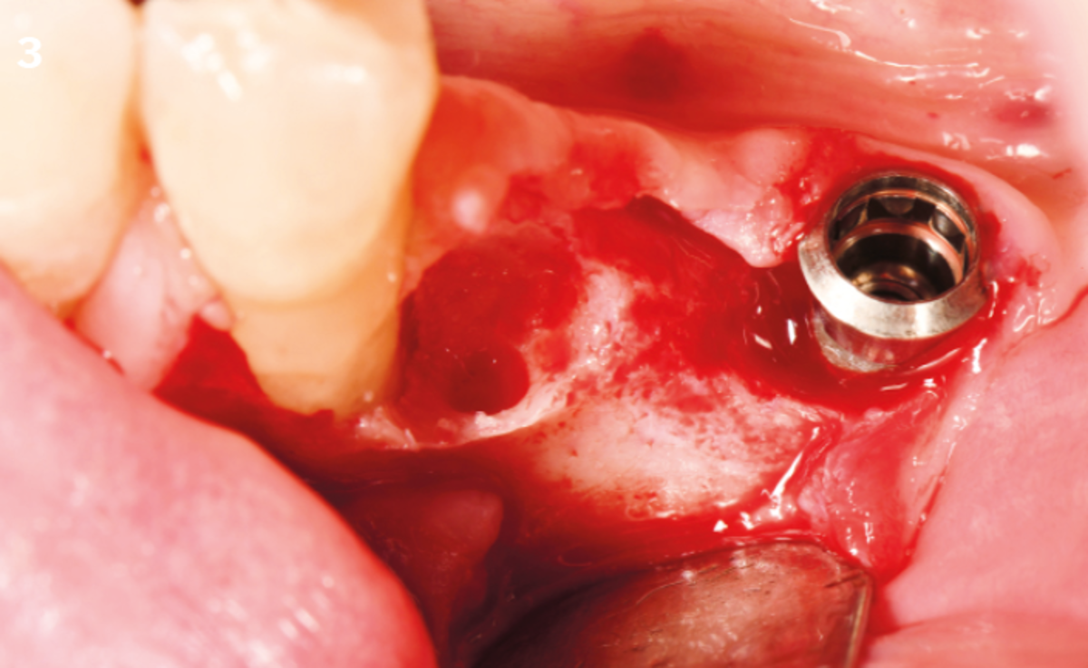 3 | Crestal and vertical incision and flap elevation; defects are visible, cleaning with the AIR-Flow® and decontamination with 0.2% CHX