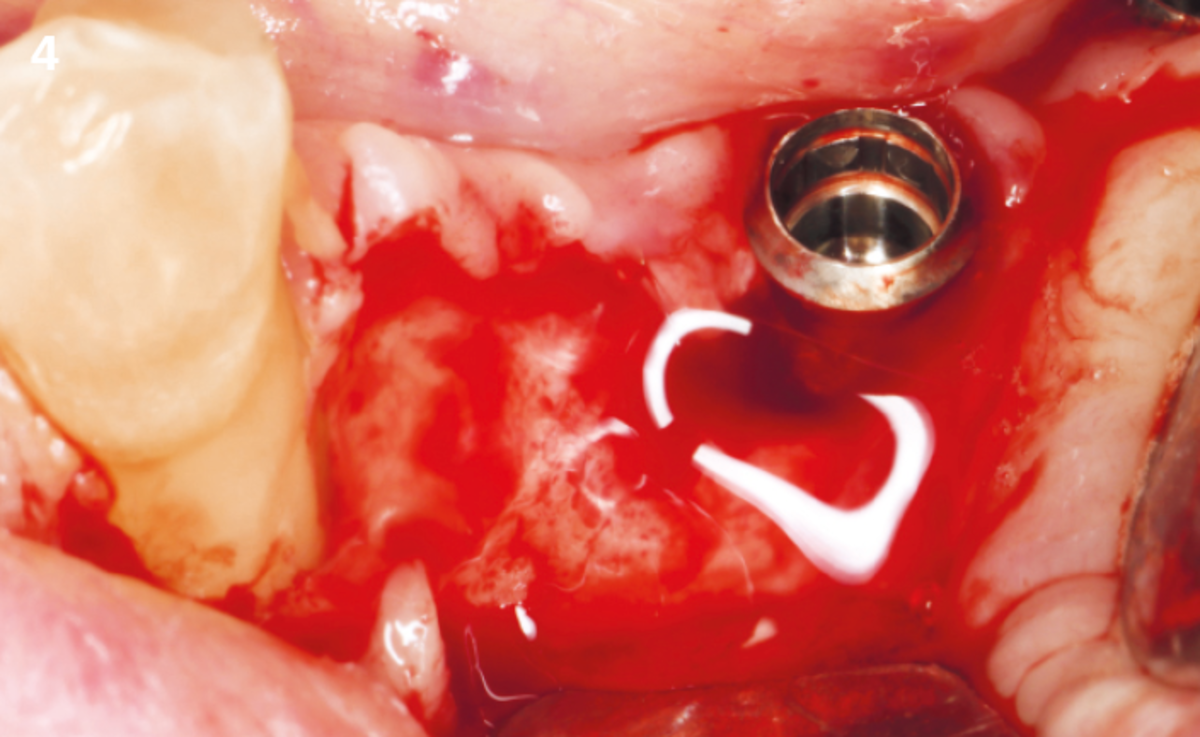 4 | Application of REGENFAST® before the addition of Geistlich Bio-Oss®