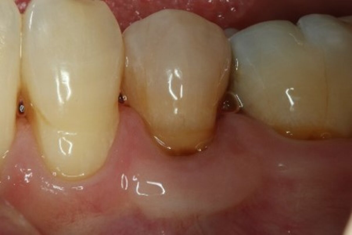 Recession coverage with free gingival graft- 5-year follow-up