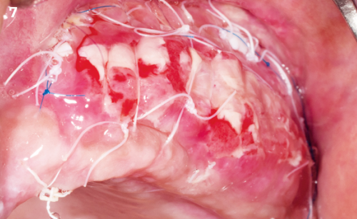 7 | Suture removal at 10 days except resorbable sutures. Soft-tissue healing is fast with low inflammation. The harvesting site is already
healed.