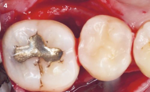 4 | Intraoperative occlusal view of the infrabony defect