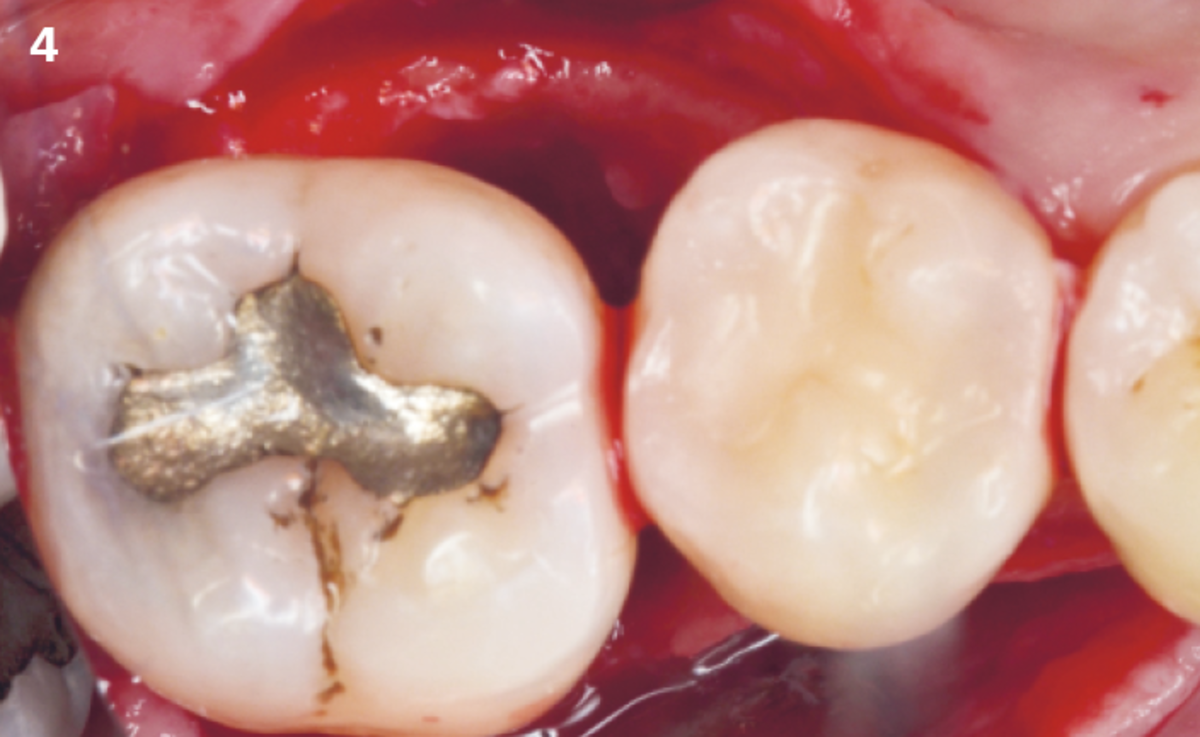 4 | Intraoperative occlusal view of the infrabony defect