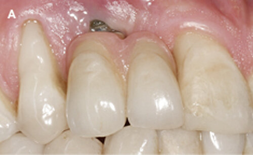 A | Initial clinical situation of implant-supported crown in area 13 with mesial cantilever extension.