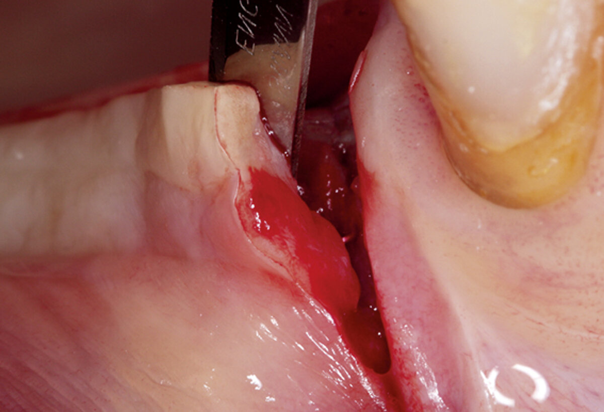 4/6 Partial thickness flap elevation on the buccal side 4 months after implant placement and soft tissue thickening.