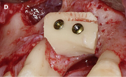 D | Sinus floor elevation and bone block from the retromolar area used for augmentation of the site 13 (courtesy of Prof. V. Chappuis, University of Bern, Switzerland).