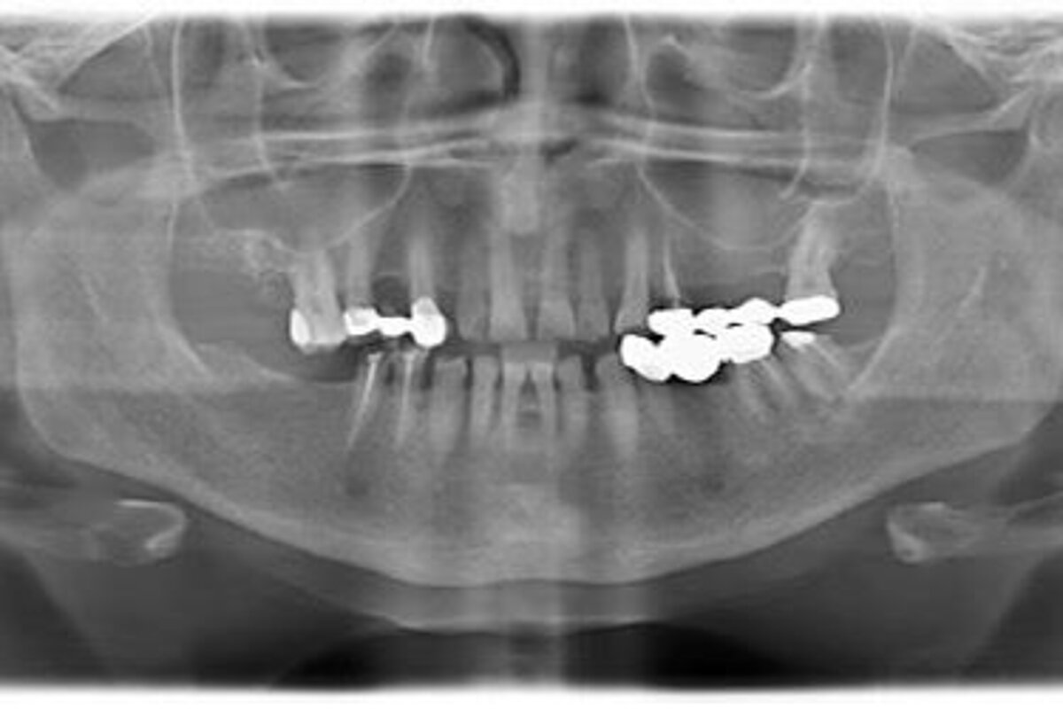 Initial clinical situation shown in Orthopantomography (OPG)