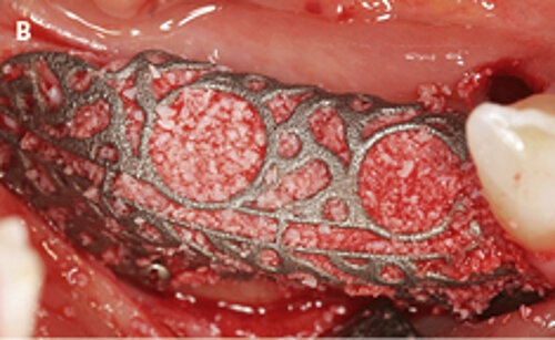 B | The augmented site with autologous 
bone chips mixed with Geistlich Bio-Oss granules in a 50:50 ratio augmentation. 