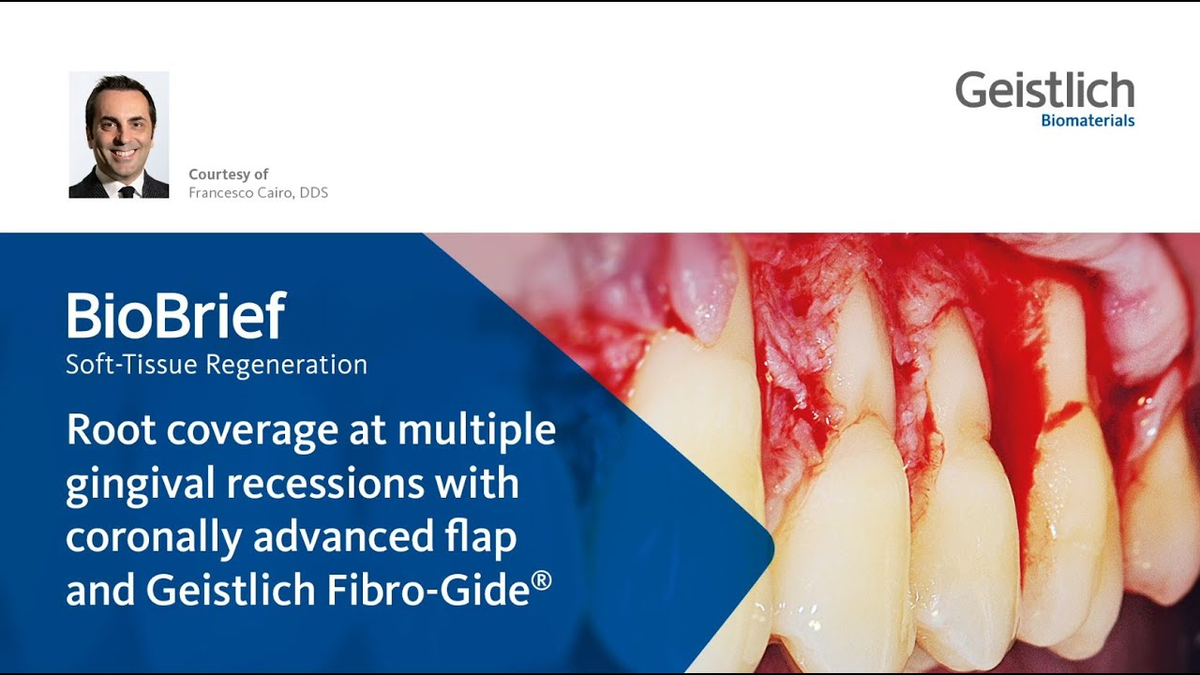 Root coverage at multiple gingival recessions with coronally advanced flap and Geistlich Fibro-Gide®