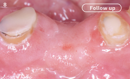 8 | Perfectly healthy tissues with no signs of pathology three months after the surgery.