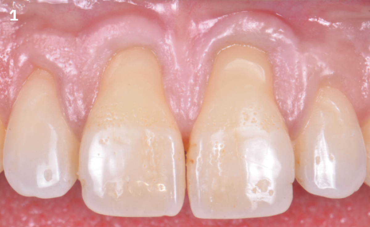 1 | Initial situation: teeth 11 and 21 present with gingival recession, root abrasion and preserved cement-enamel junction.