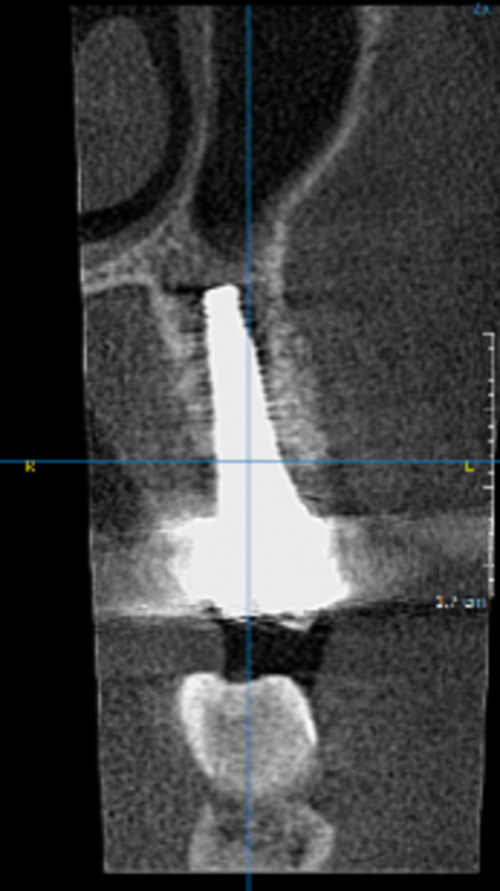 and 4-year follow-ups (right) showing integration and stability of Geistlich Bio-Oss® with the open healing approach