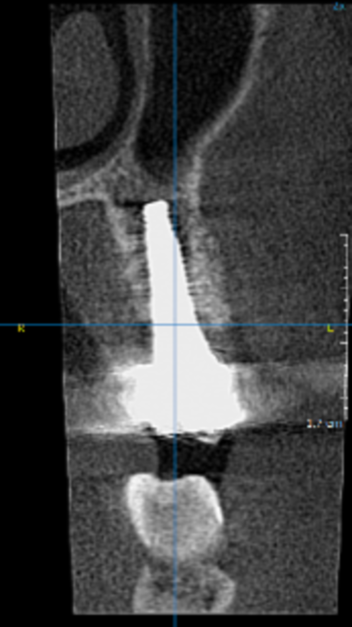 4-year follow-up showing integration and stability of Geistlich Bio-Oss® with the open healing approach