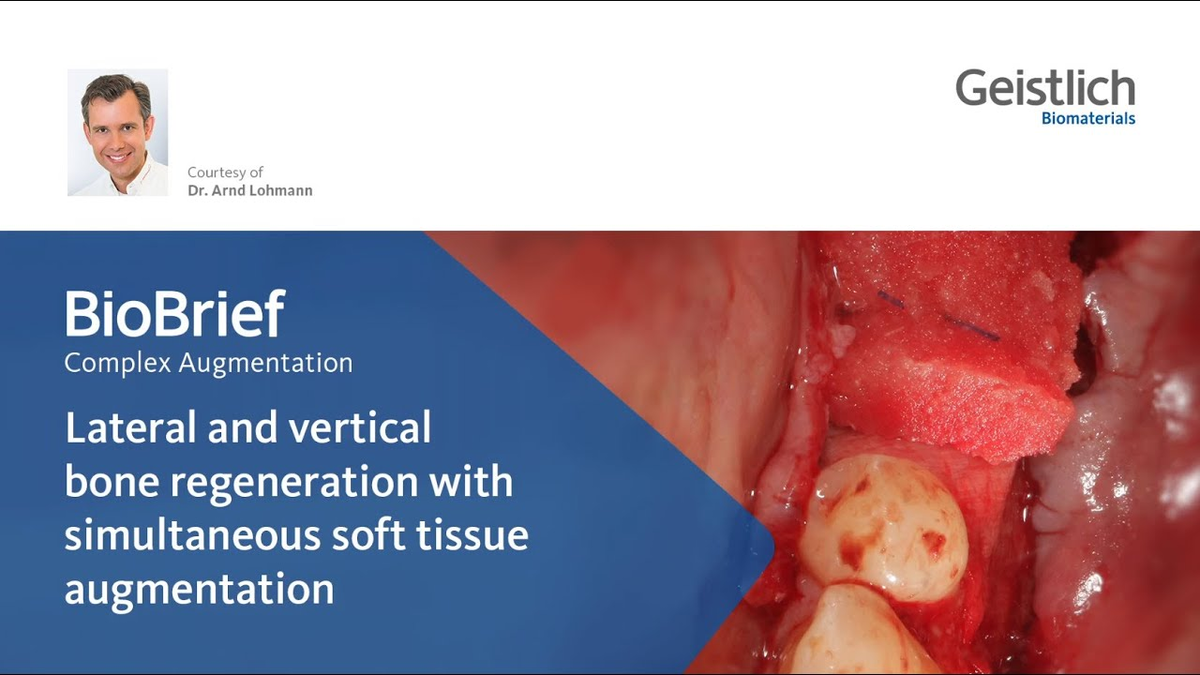 Lateral and vertical bone regeneration with simultaneous soft tissue augmentation