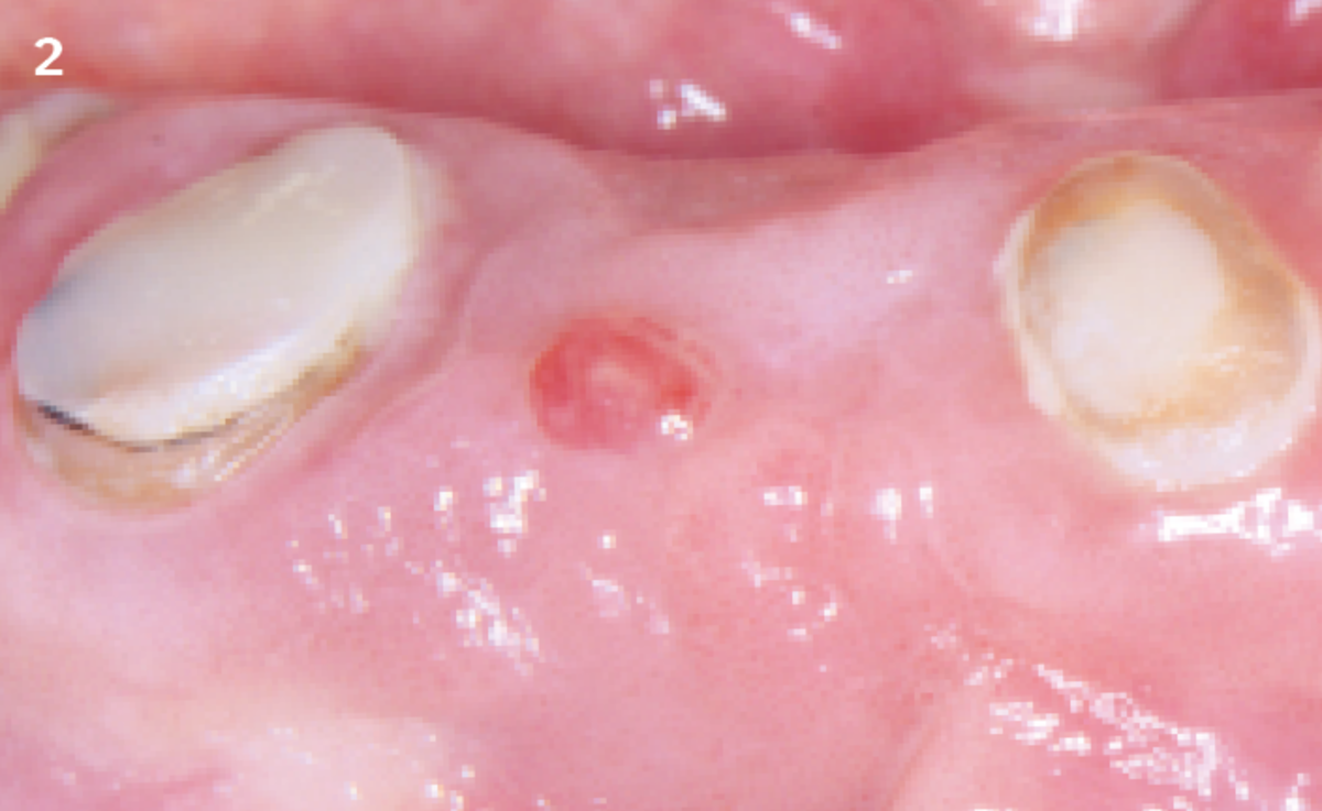 2 | Fistula in relation to the edentulous crest through which the bone crest can be probed.