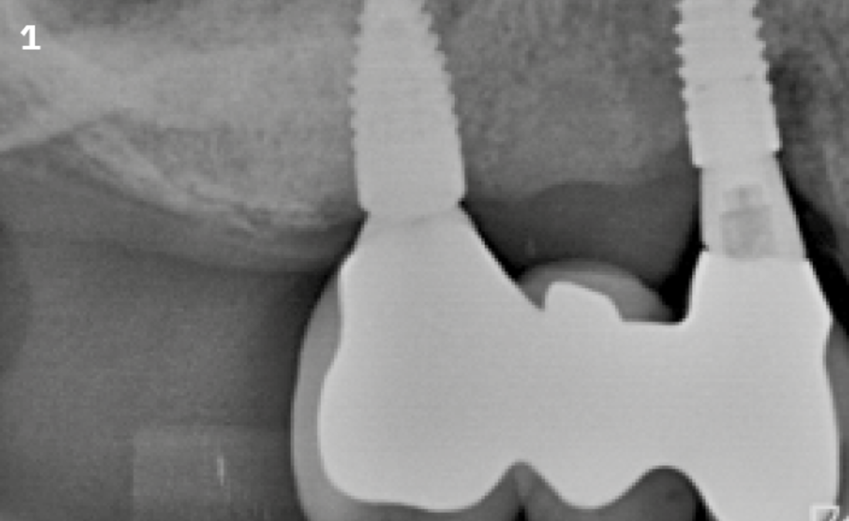 1 | Radiographic image of the initial situation: Implant at site 14 shows peri-implant bone loss