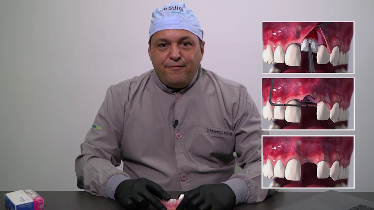 Geistlich Implanteperio Dr Paulo Fernando Mesquita