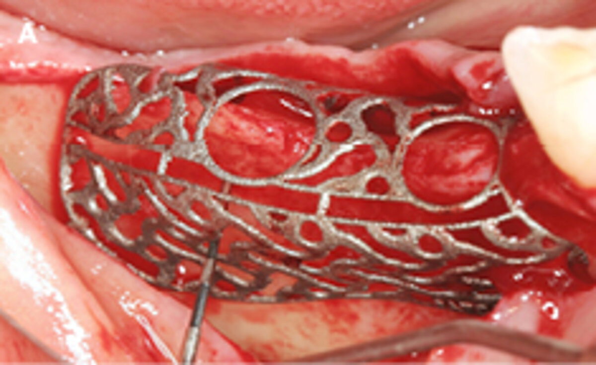 A | Intraoperative fitting of the customized titanium scaffold- see the extensive deficiency in the alveolar ridge.