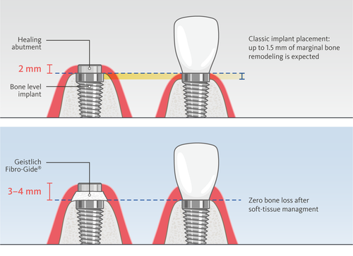 Fig. 1: Classic implant placement vs the “zero bone loss concepts” by T. Linkevičius –
thicker soft tissue protects the bone around implant from remodeling.