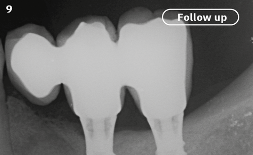9 | Radiographic control at 1 year shows a stable bony situation