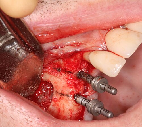 Fig 6- Implant osteotomy
