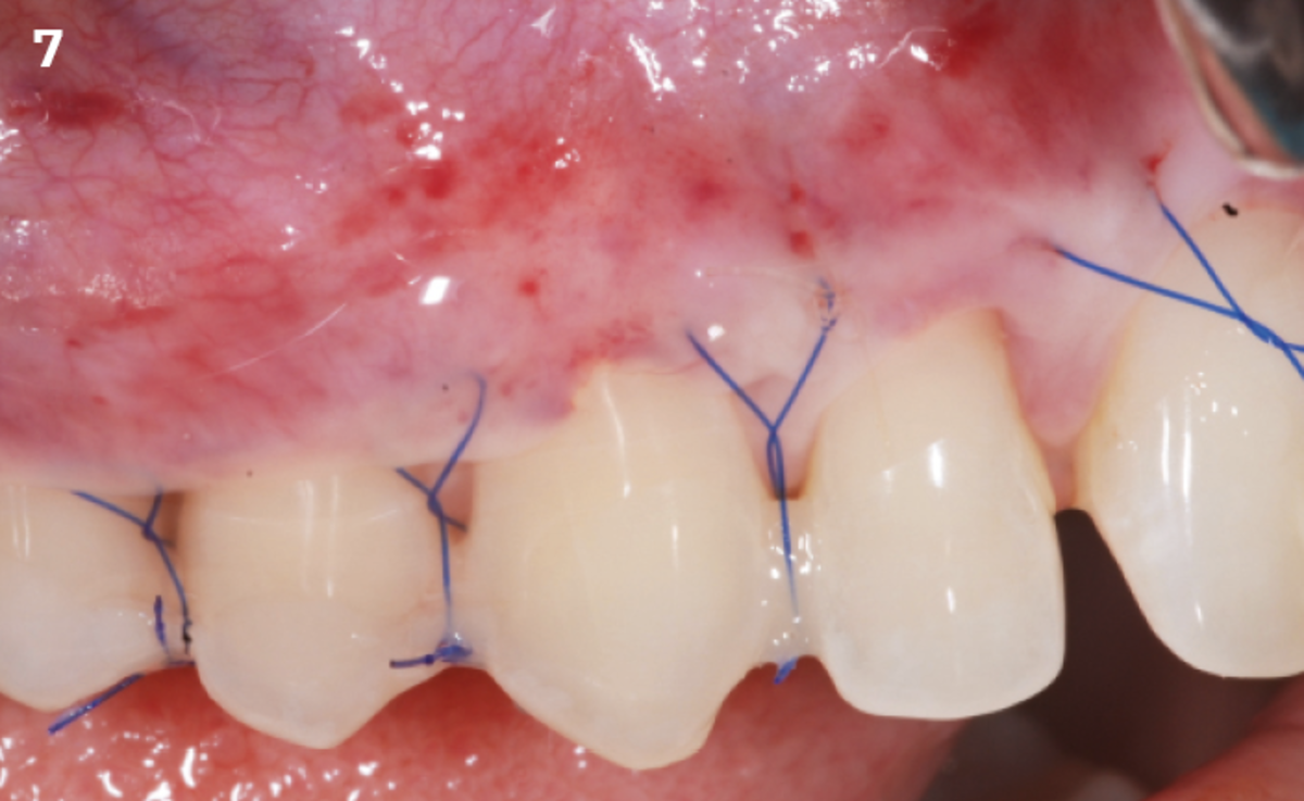 7 | Horizontal suspended sutures advancing the flap coronally. Graft totally covered by the flap.
REGENFAST® applied over the flap and the sutures.